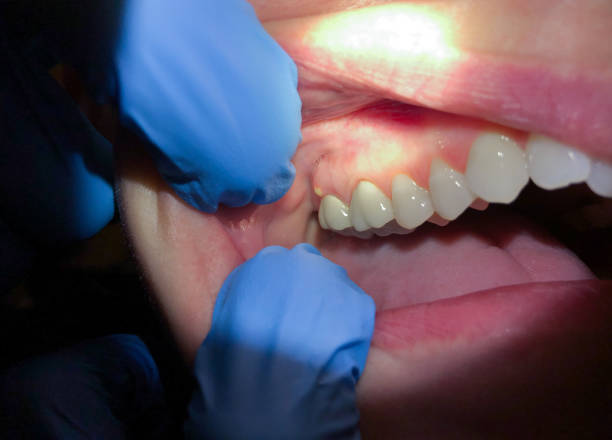 Best Tooth Infection Emergency Dentist  in Girard, IL